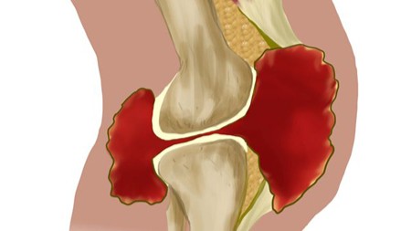 Joint Swelling or Synovitis