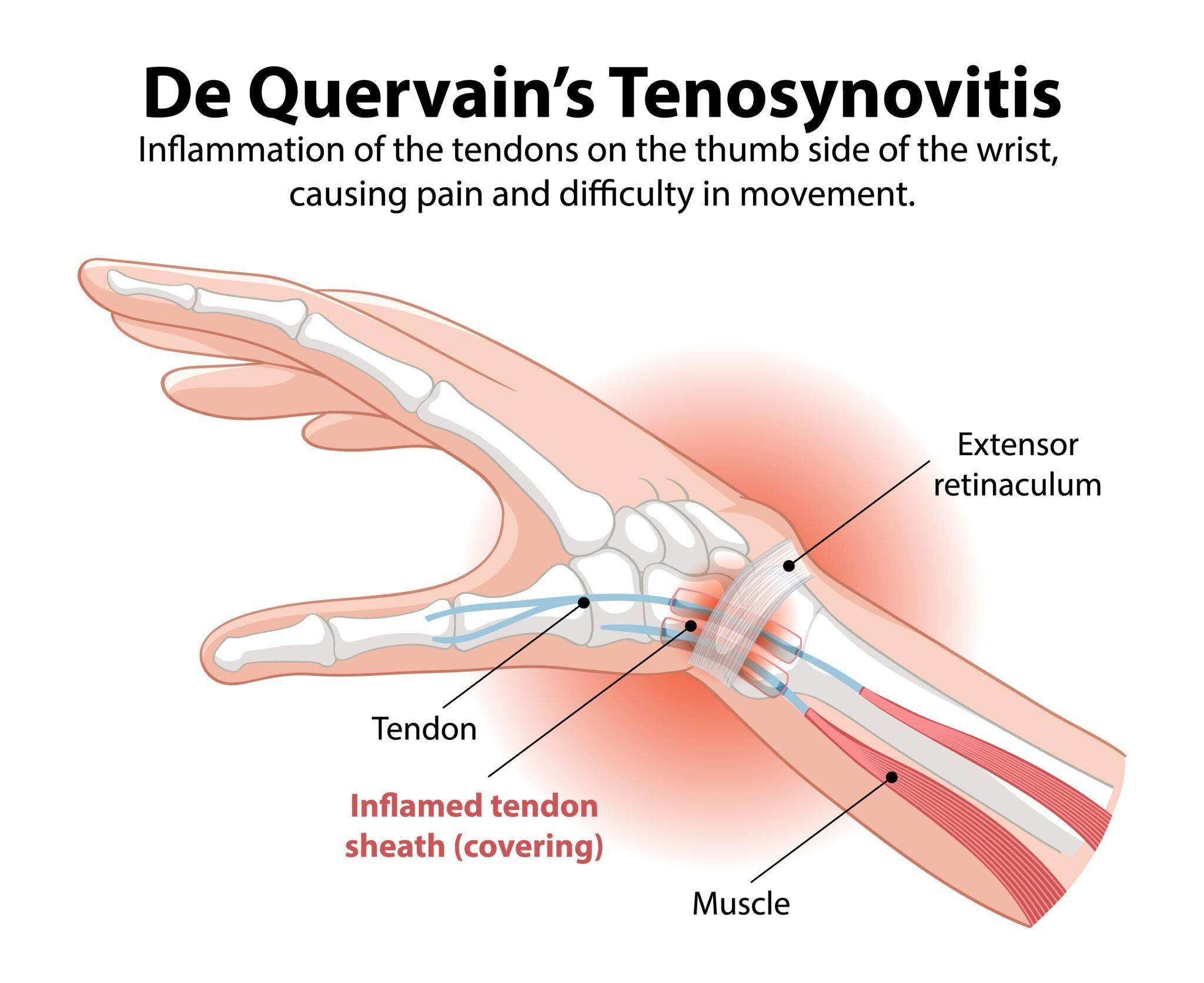 Hand Surgeon in Abu Dhabi for De Quervain’s Syndrome – Dr. Jayakrishnan Kurup Explains Thumb-Side Wrist Pain